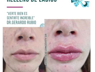 Ácido hialurónico antes y después - 867158