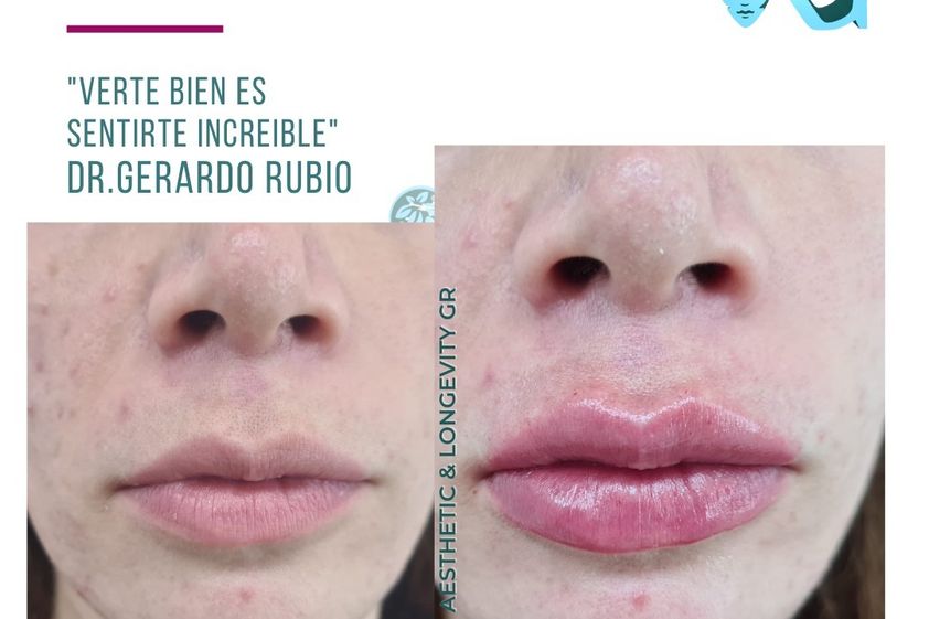 Ácido hialurónico antes y después - 867158