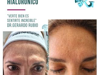 Ácido hialurónico antes y después - 867159