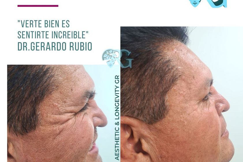 Toxina botulínica antes y después - 867160