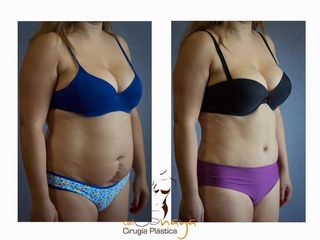 Antes y después de Abdominoplastía