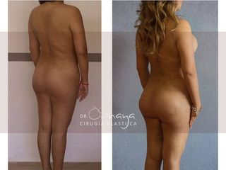Antes y después de Lipoescultura 