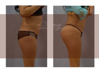 Antes y después de Lipoinyección
