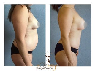 Antes y después de Abdominoplastía