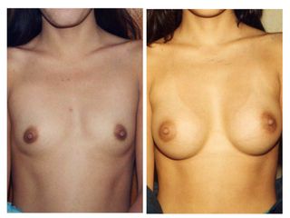 Antes y después de Aumento de busto