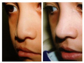 Antes y después de Nariz de Labio Leporino 