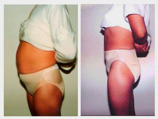 Antes y después de Abdominoplastia