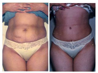 Antes y después de Abdominoplastia