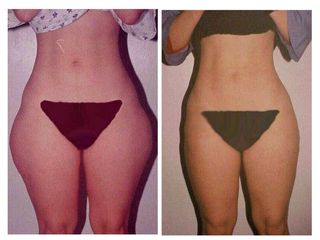 Antes y después de Lipoescultura