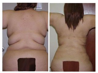Antes y después de Lipoescultura