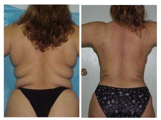 Antes y después de Lipoescultura