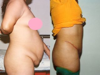 Antes y después de Abdominoplastia