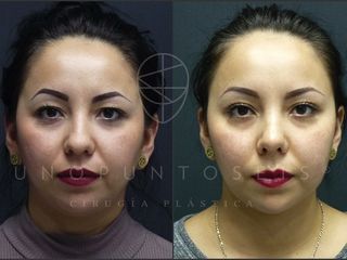 Antes y después de blefaroplastia. Comparativo Ale frente