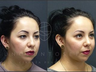 Antes y después de Rinoplastia