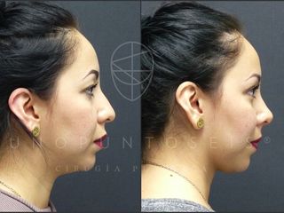 Antes y después de Rinoplastia