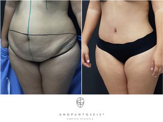 Antes y después de Lipo-Abdominoplastía