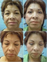 Antes y después de Rejuvenecimiento facial