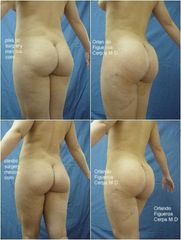 Antes y después de Body enhancement - Gluteoplastia