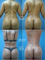 Antes y después de Body enhancement - Gluteoplastia