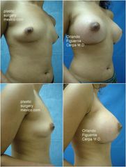 Antes y después de Breast enhancement