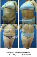 Antes y después de Full Abdominoplasty, lipo