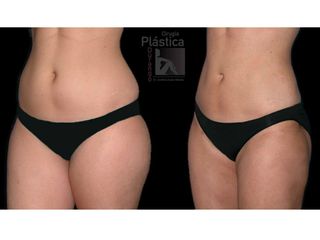 Antes y después de Liposucción