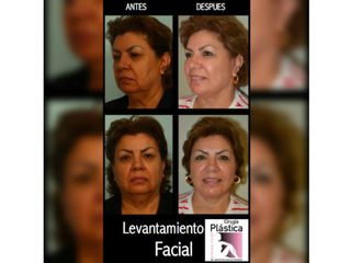 Antes y después de levantamiento facial