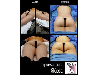 Antes y después de lipoescultura glútea