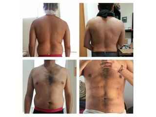 Antes y después de liposucción para hombre