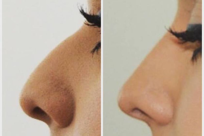 Rinoplastia antes y después - 605659