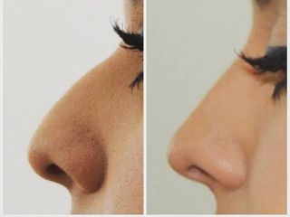 Antes y después de Rinoplastia