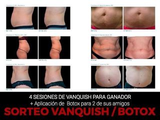 Antes y después de Liposucción con radiofrecuencia