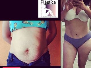 Antes y después de Abdominoplastia
