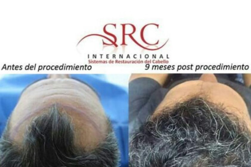 Trasplante de cabello antes y después - 631012