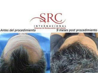 Trasplante de cabello - 631012