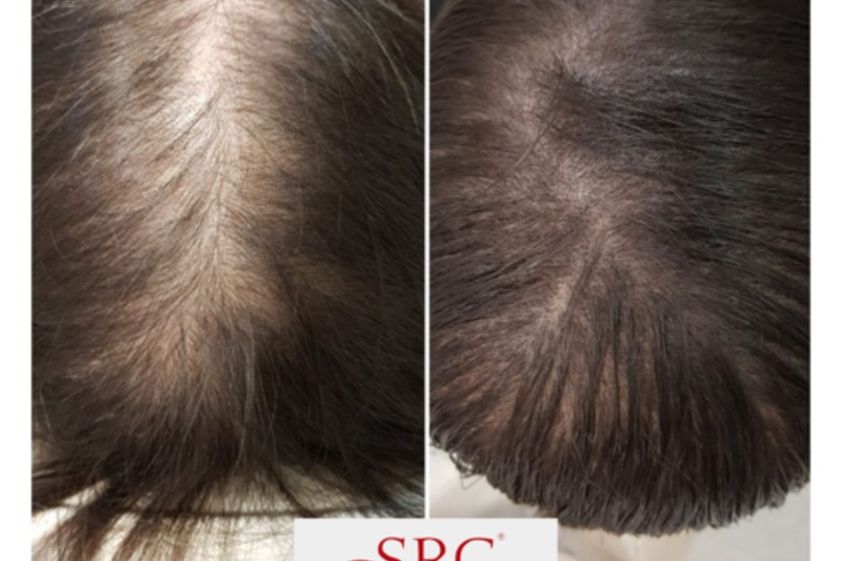 Micropigmentación antes y después - 637022