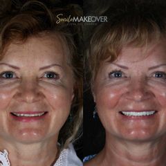 Antes y después de Blanqueamiento dental - Smile Makeover Playa Del Carmen