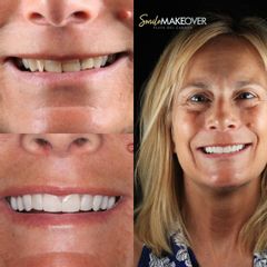 Antes y después de Ortodoncia - Smile Makeover Playa Del Carmen
