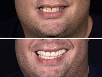 Implantes Dentales - 663581