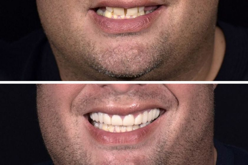 Implantes Dentales antes y después - 663581