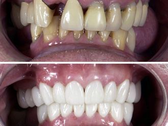 Implantes Dentales - 663582