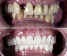 Antes y después de Implantes dentales - Smile Makeover Playa Del Carmen
