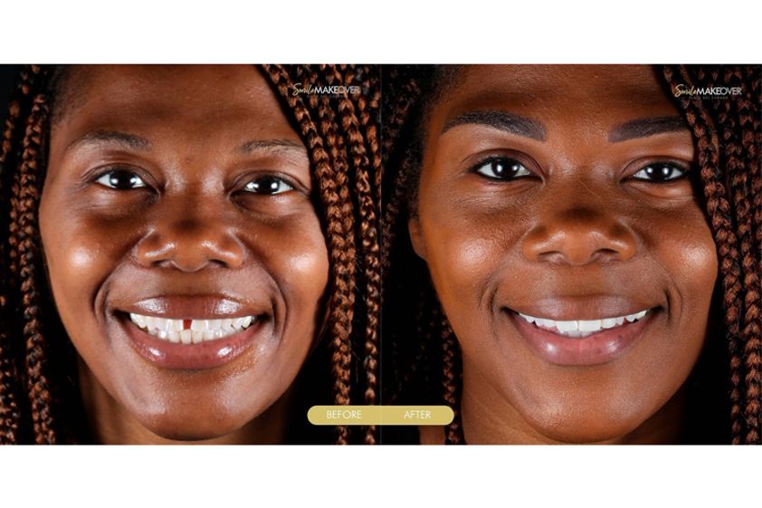 Implantes Dentales antes y después - 663583