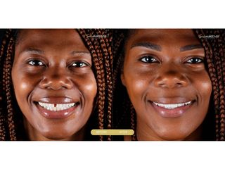 Antes y después de Implantes dentales - Smile Makeover Playa Del Carmen