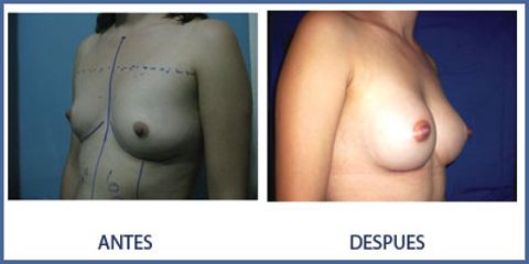 Antes y después de un aumento de busto