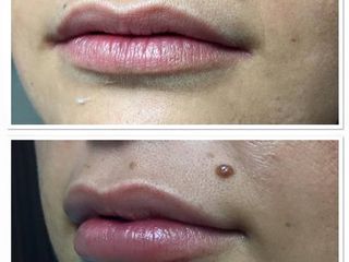 Antes y después de un aumento de labios 