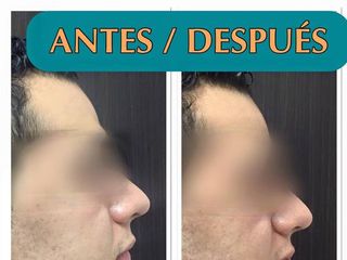 Antes y después de una Rinoplastia