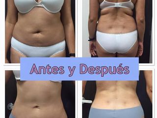 Antes y después de una Liposucción