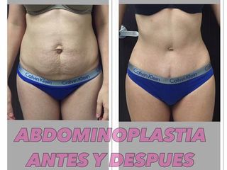 Antes y después de una Abdominoplastia