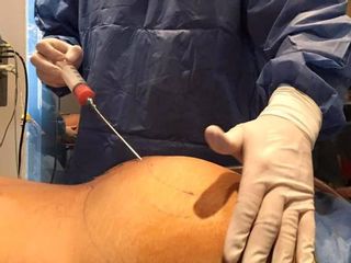  Liposucción